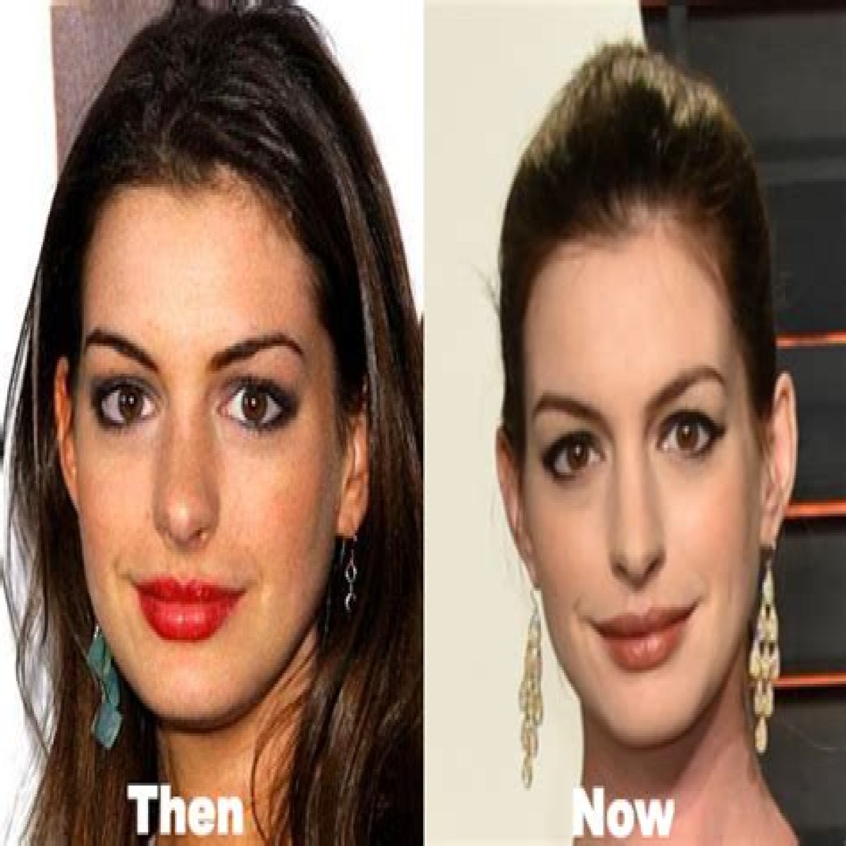 Anne Hathaway’s Plastic Surgery In 2 Rhinoplasty, Boob Job, & Botox Injection Rumors Examined!